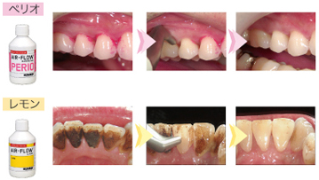 エアフローでプラークや着色汚れを綺麗にできます