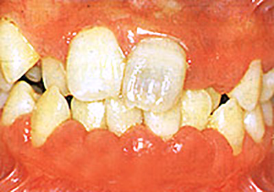 歯周病治療前
